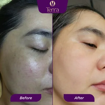 Hình ảnh trước và sau khi xoá nám của chị Ngọc