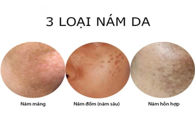 Hình ảnh so sánh trực quan nám mảng (nám nông) và nám nội tiết (nám sâu) trên da mặt.