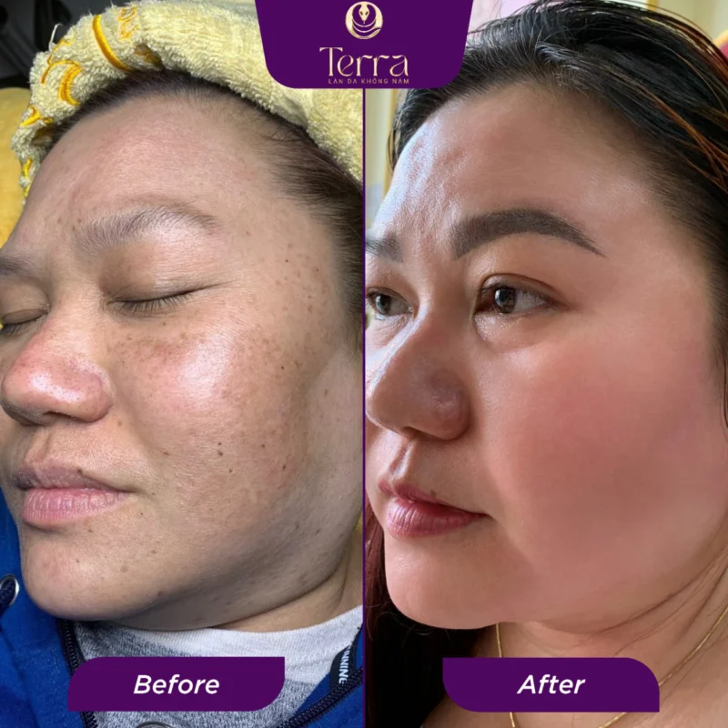 Chị Nhiên trước và sau khi trị nám - Terra