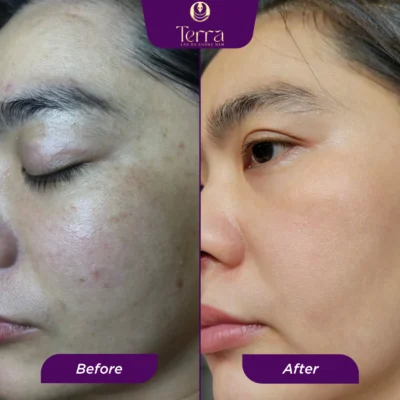 Chị Nhung trước và sau điều trị nám - Terra