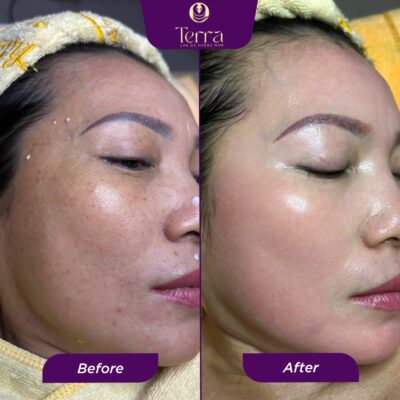 Chị Thương trước và sau khi trị nám - Terra