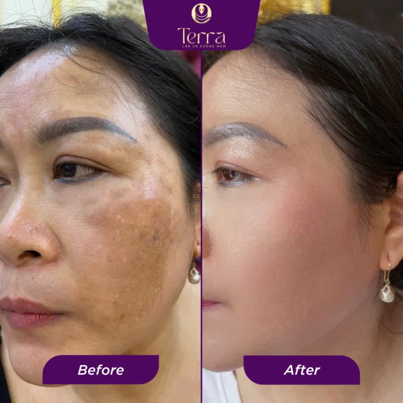 Kết quả trước và sau khi sử dụng sản phẩm TERRA, làn da trở nên sáng khỏe, nám mờ dần rõ rệt.