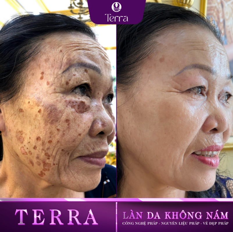 Cô Thái Trước Và Sau Điều Trị