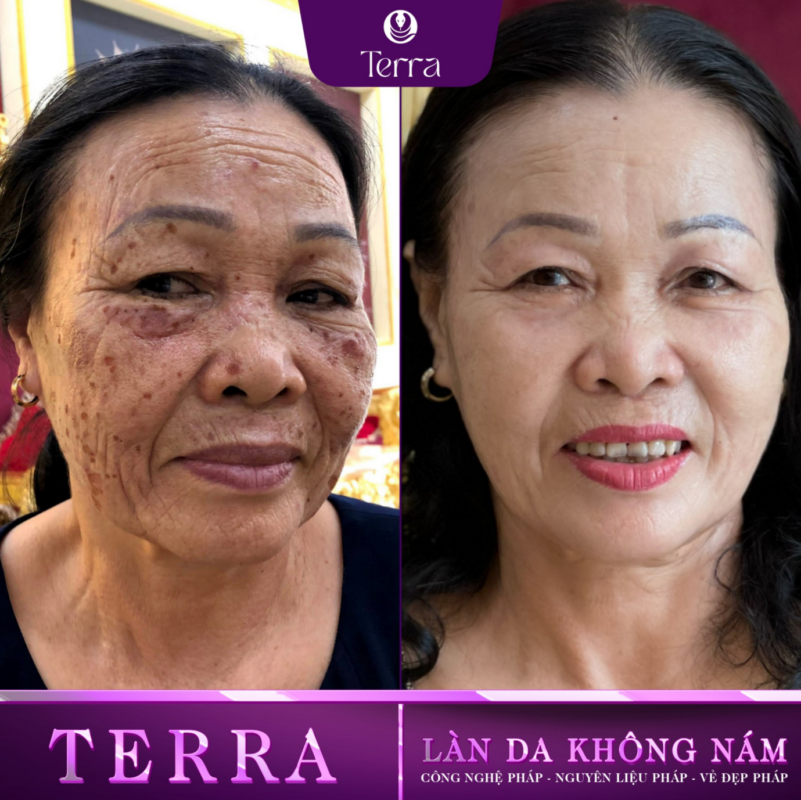 Cô Thái Trước Và Sau Điều Trị - 2