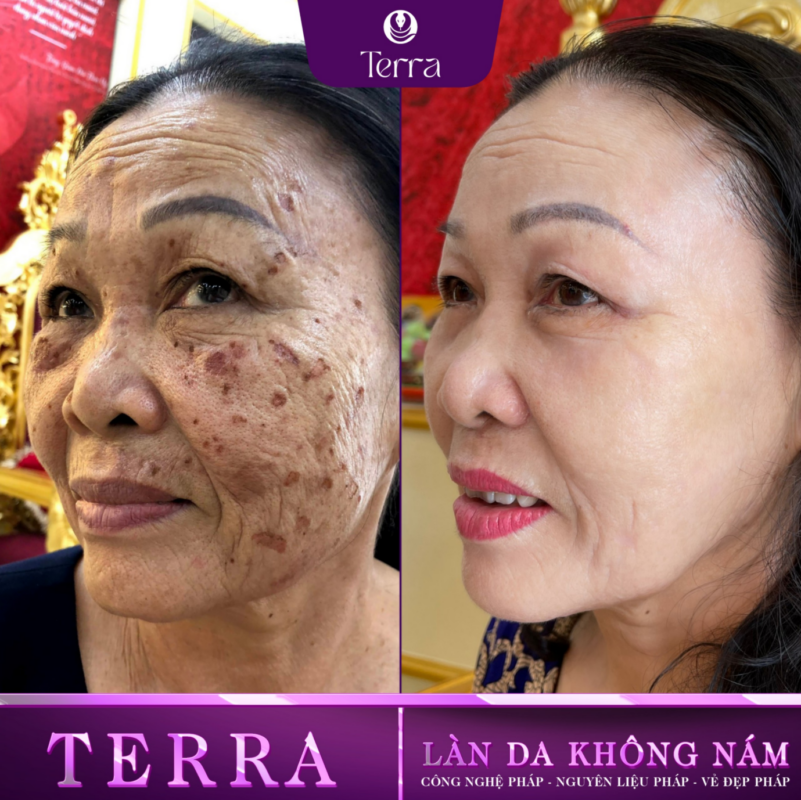 Cô Thái Trước Và Sau Điều Trị - 3