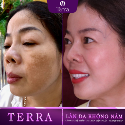 Chị Hiếu Trước và sau điều trị nám mảng chai lì - Terra