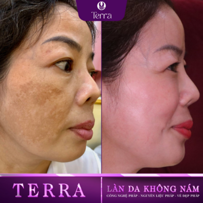 Chị Hiếu Trước và sau điều trị nám mảng chai lì - Terra