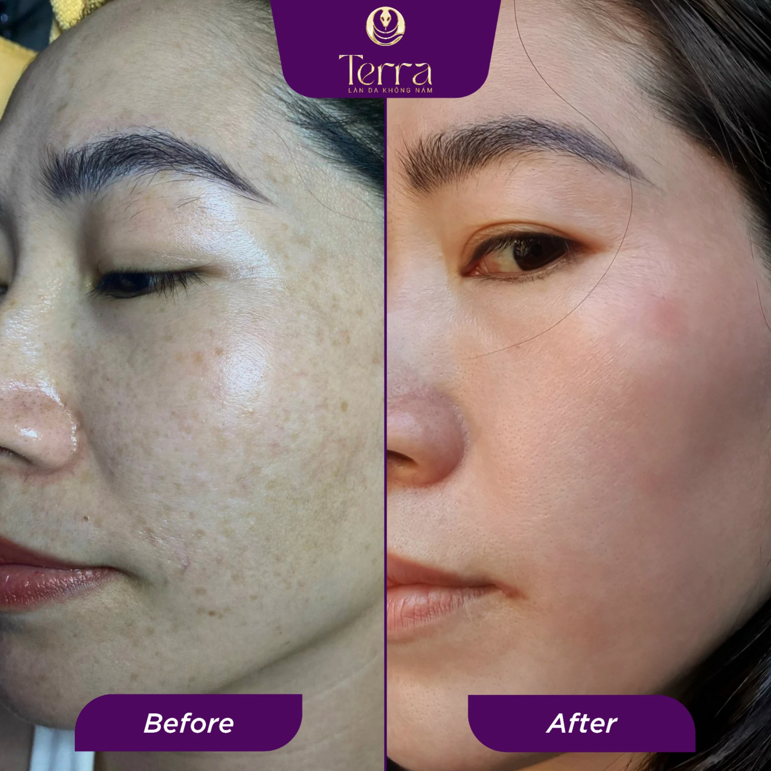 Làn da sạch nám rạng rỡ của chị Đào sau khi trị nám hiệu quả tại Thẩm mỹ viện Thảo Vy