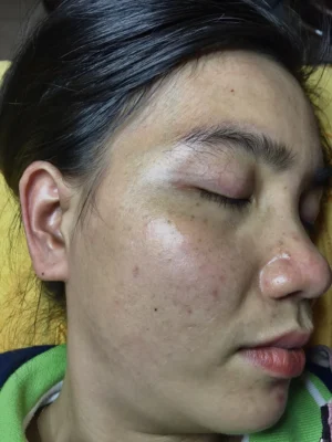 Ảnh minh họa nám chân sâu - Terra