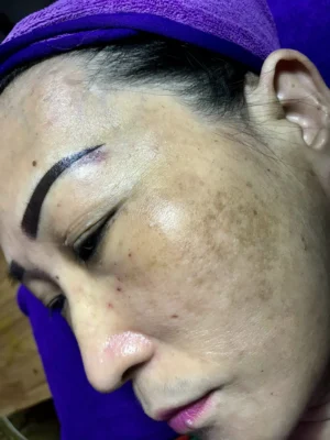 Ảnh minh họa nám mảng - Terra